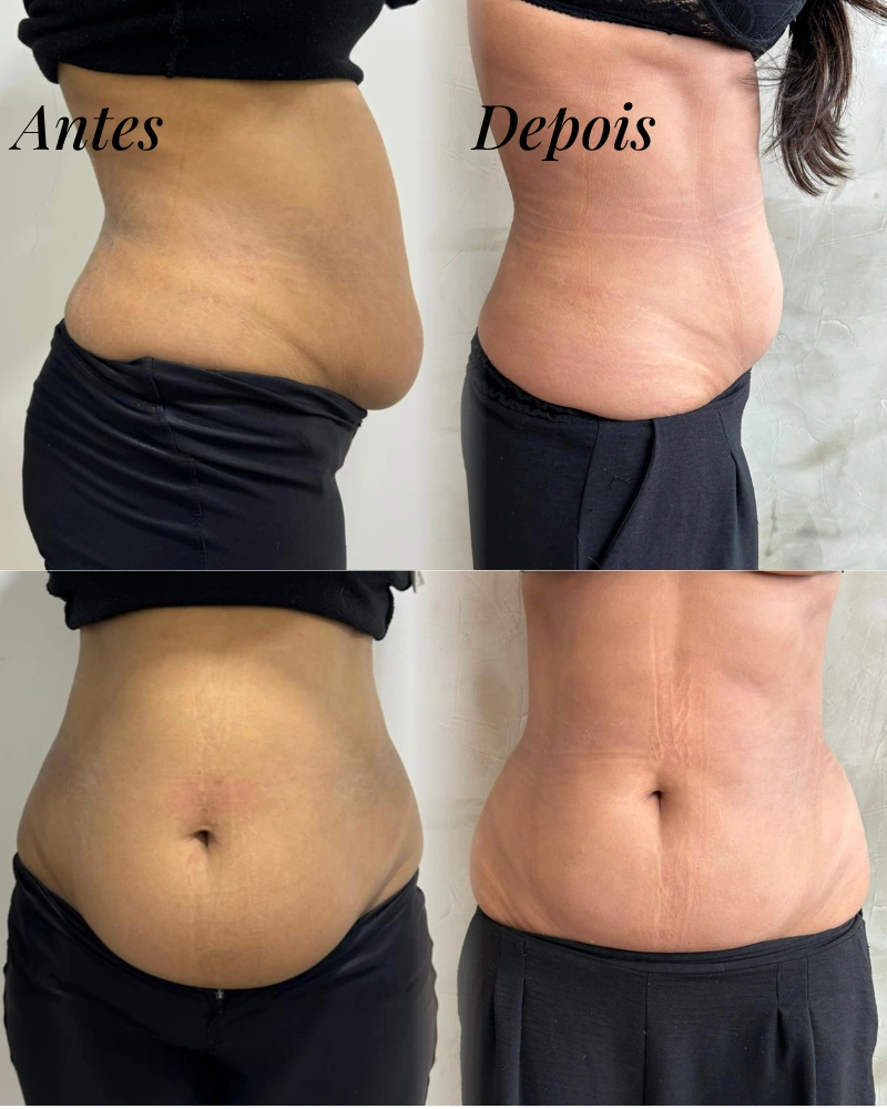 Antes e depois de protocolo corporal personalizado