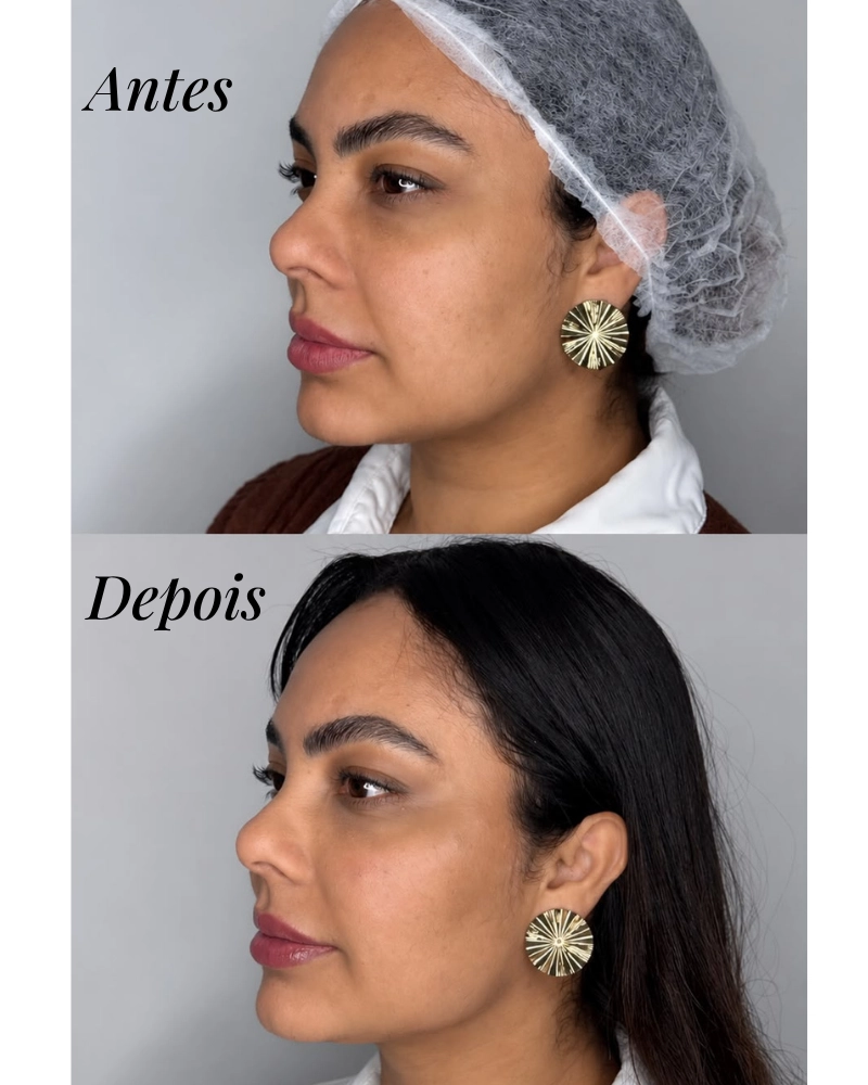 Antes e depois da harmonização facial