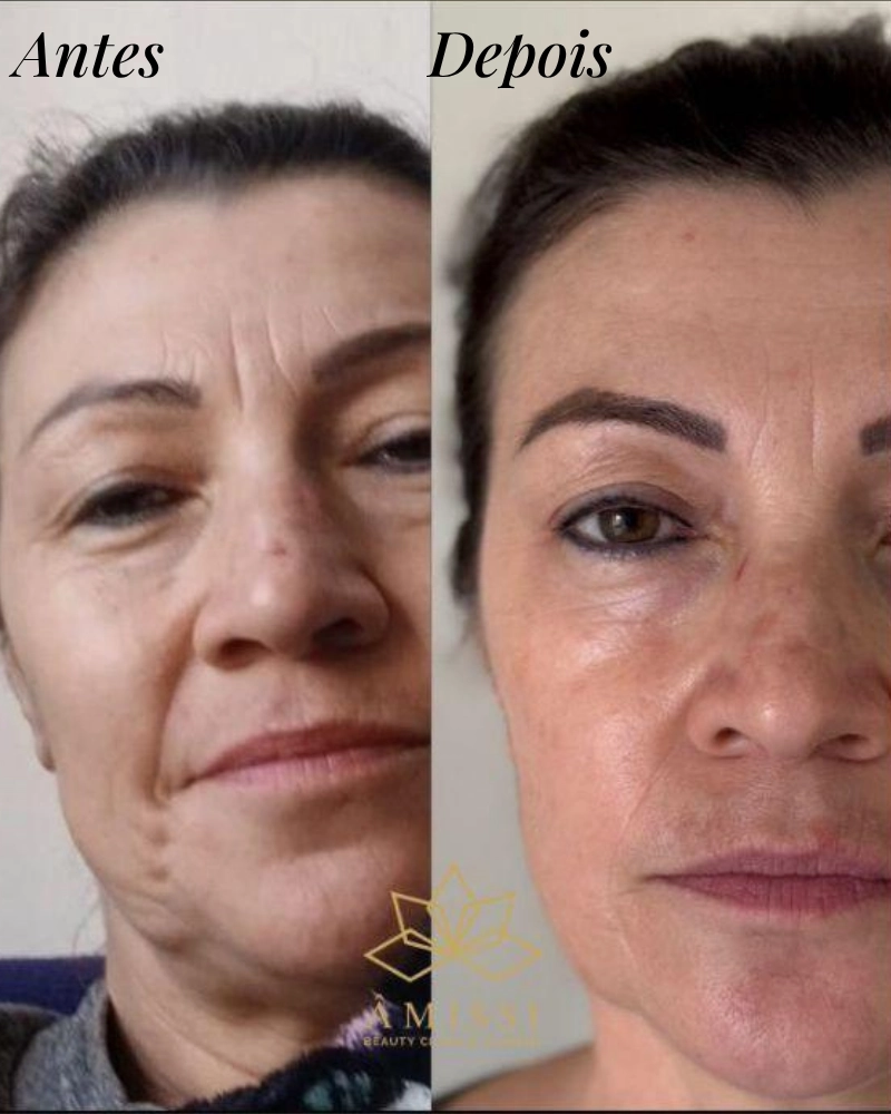 Antes do tratamento de estética regenerativa