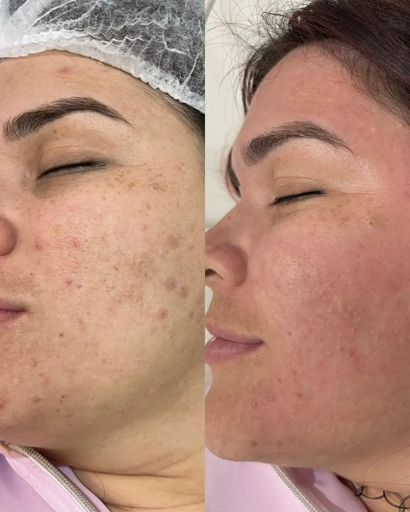 Antes e depois da micropigmentação labial