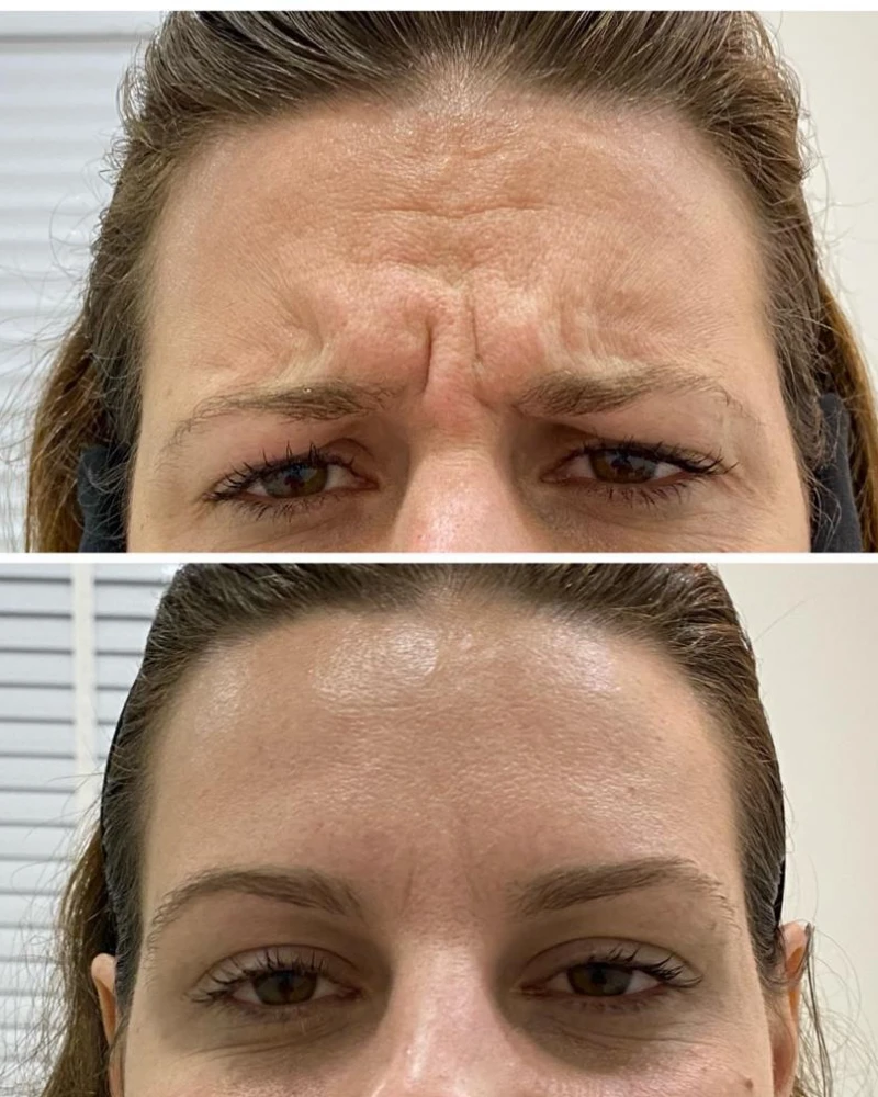 Antes do tratamento de estética regenerativa