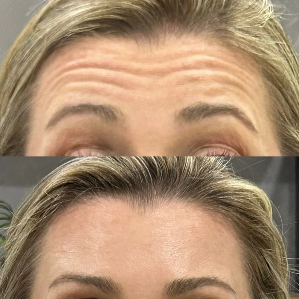 Resultado natural do método Botox de tratamento facial