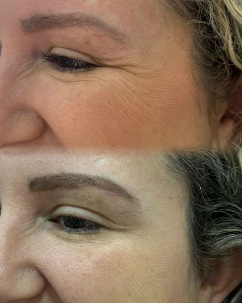 Antes e depois do método Botox