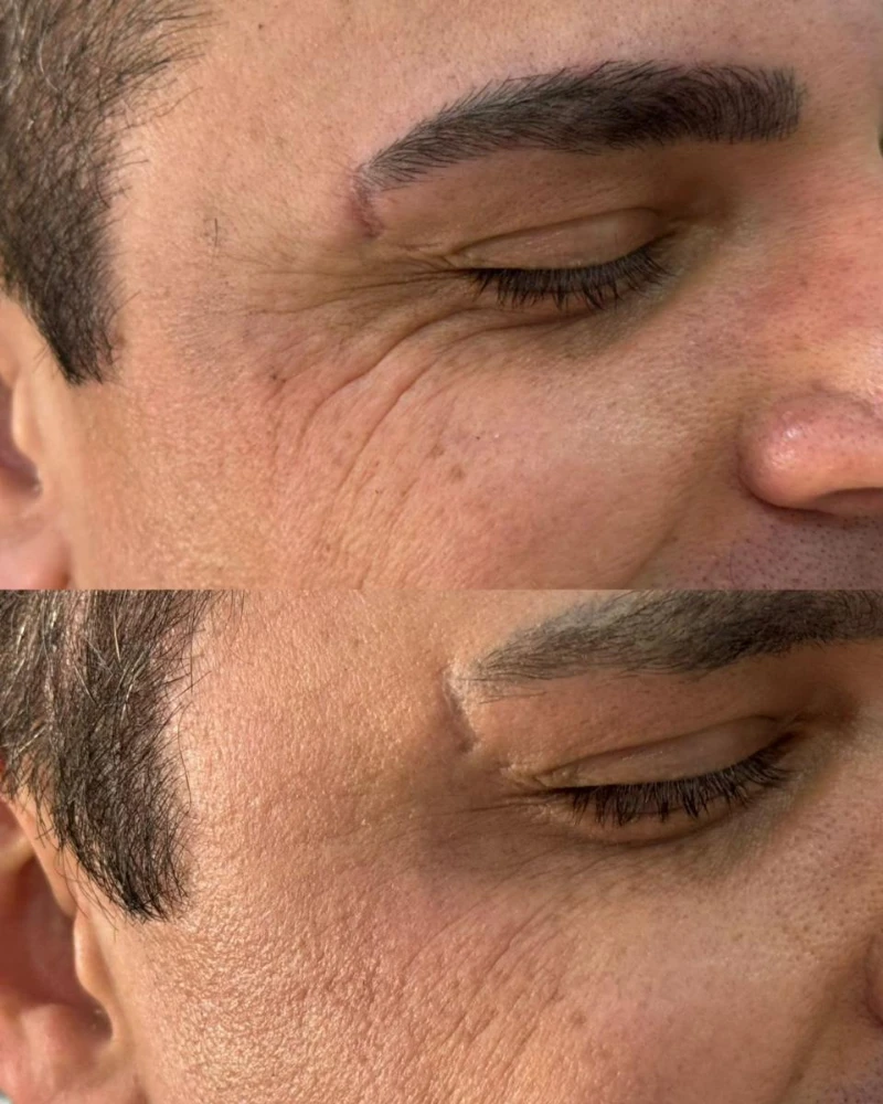Antes e depois do tratamento das linhas de expressão