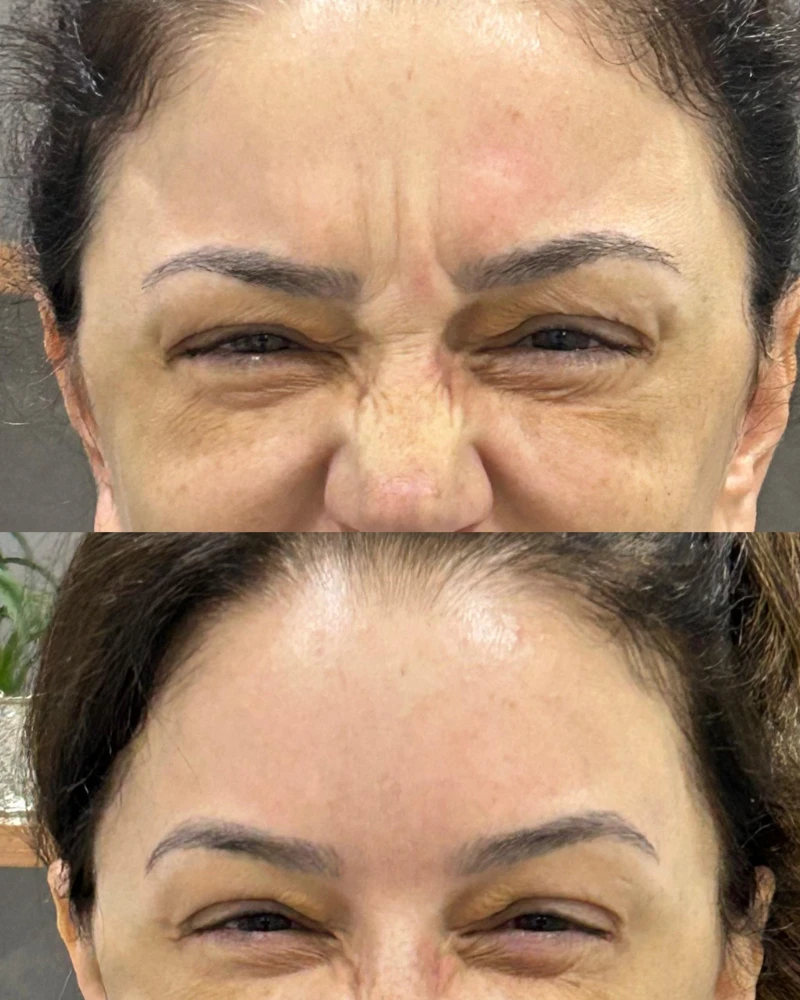 Resultado de Botox com expressão natural
