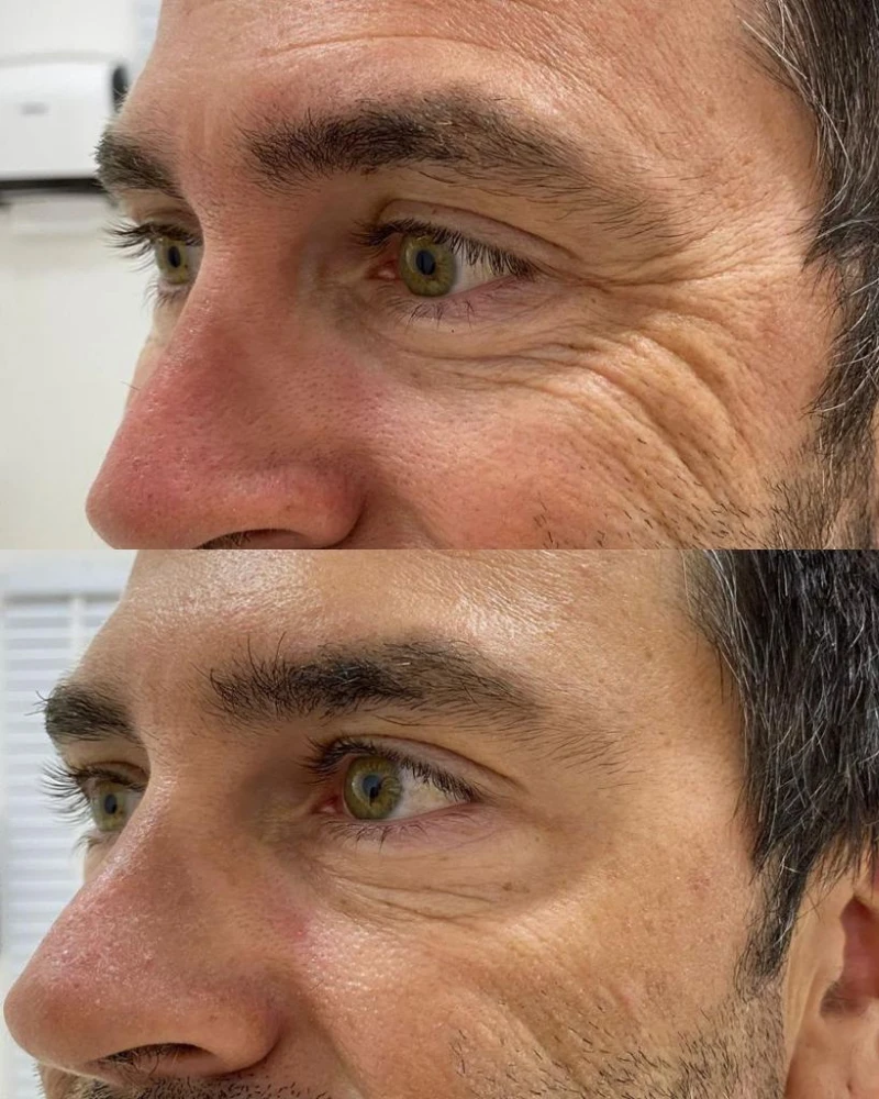 Comparativo antes e depois do método Botox