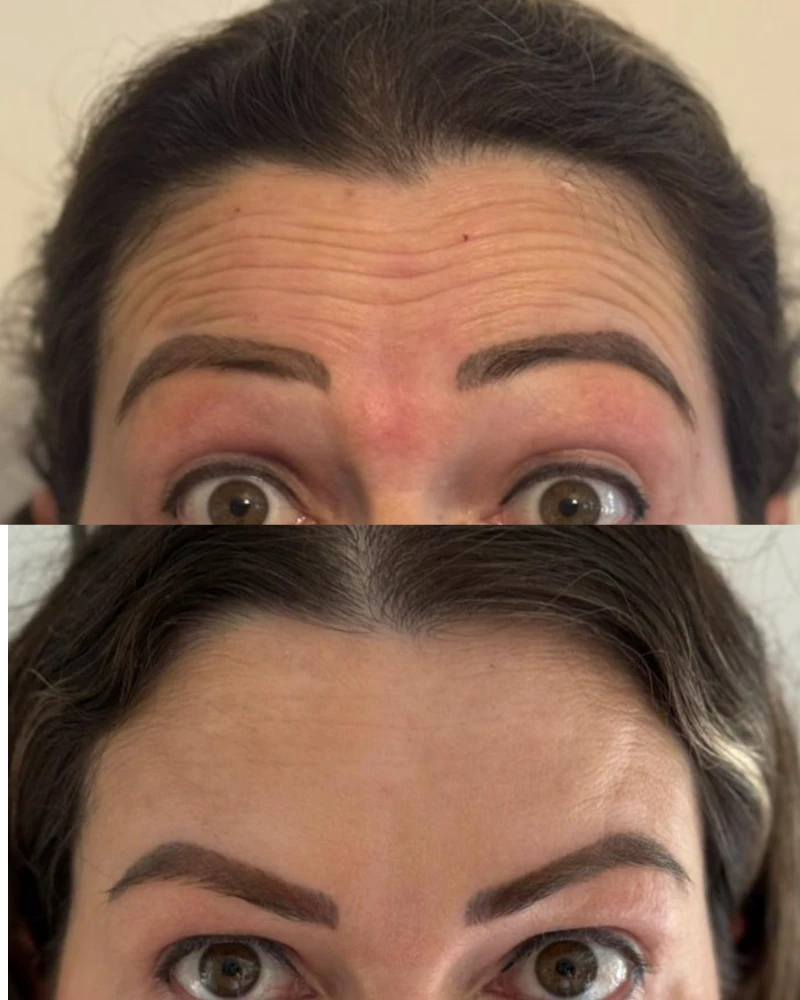 Resultado natural de tratamento com Botox
