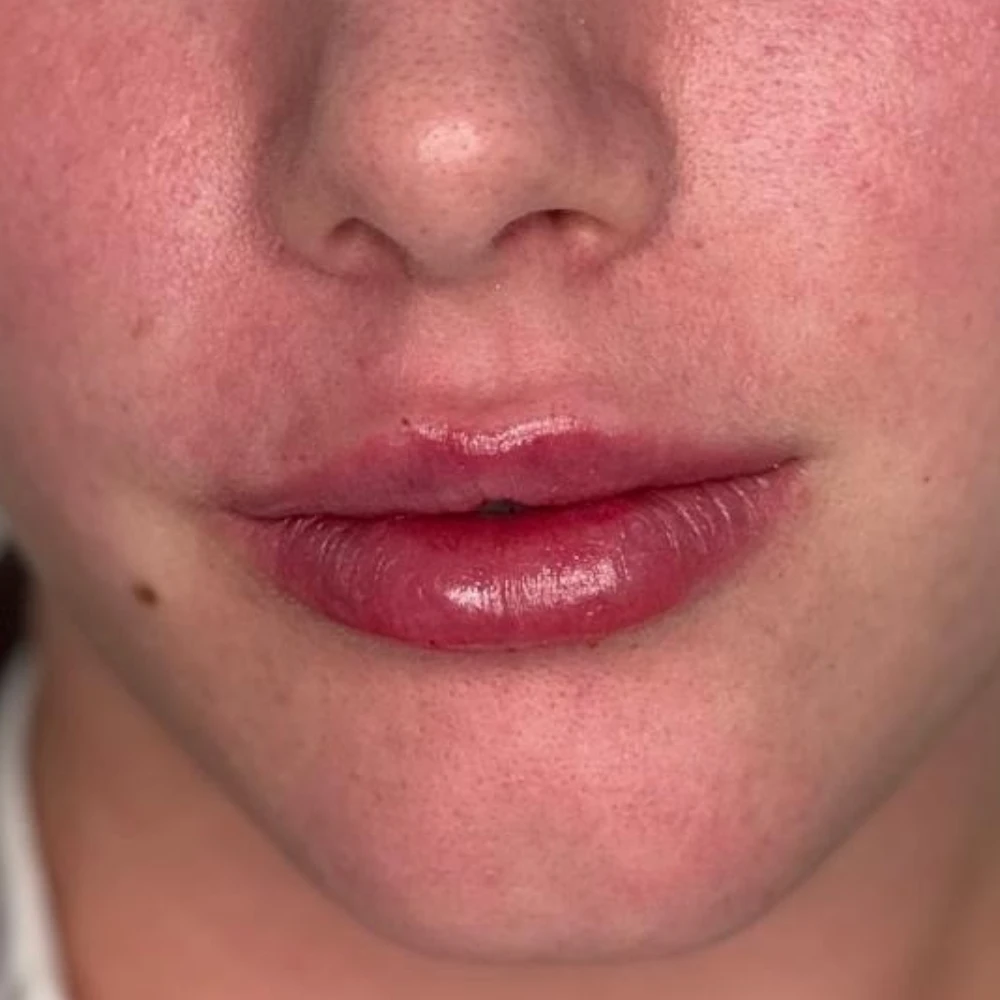 Resultado natural do método Preenchimento Labial de tratamento facial