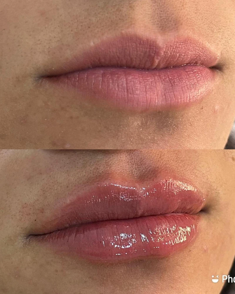 Antes e depois do método Preenchimento Labial