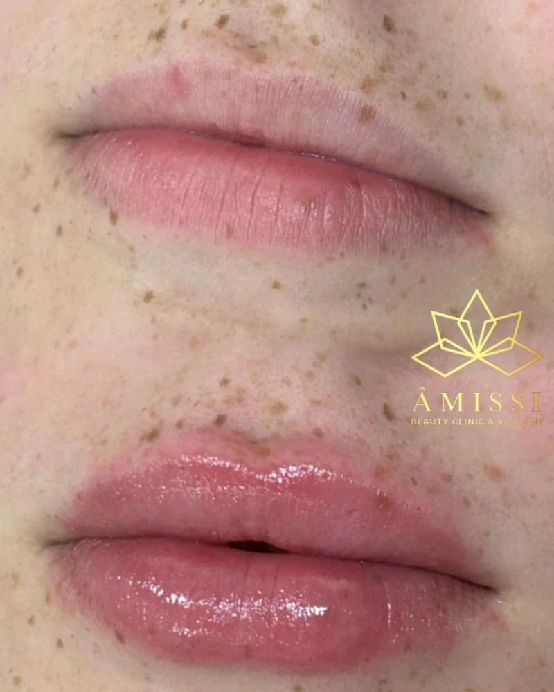 Resultado natural de tratamento com Preenchimento Labial