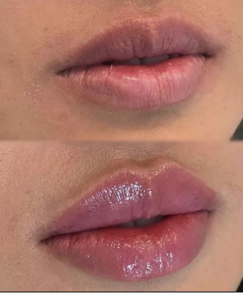 Antes e depois do Preenchimento Labial