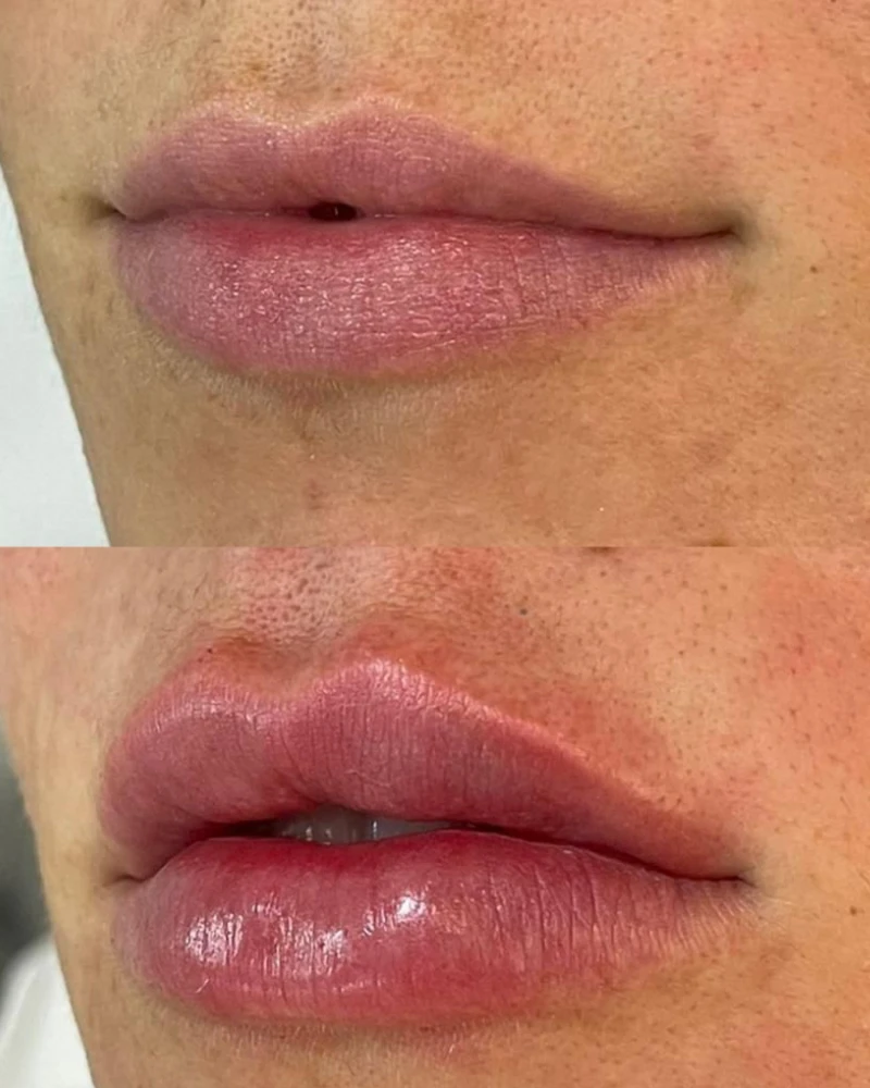 Resultado de Preenchimento Labial com expressão natural