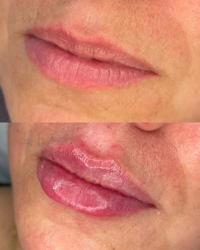 Comparativo antes e depois do método Preenchimento Labial