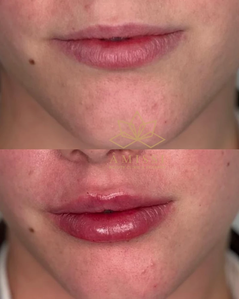 Resultado natural de tratamento com Preenchimento Labial
