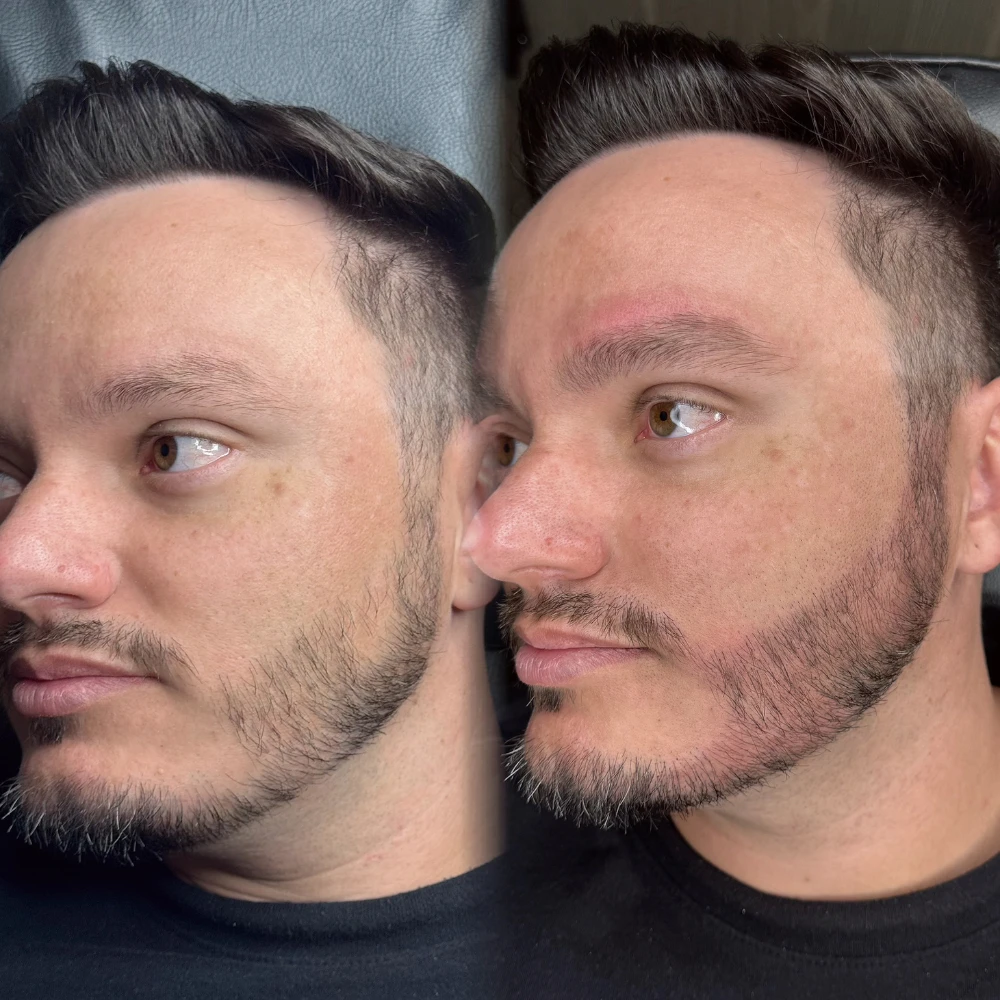 Resultado natural do método Barba de micropigmentação