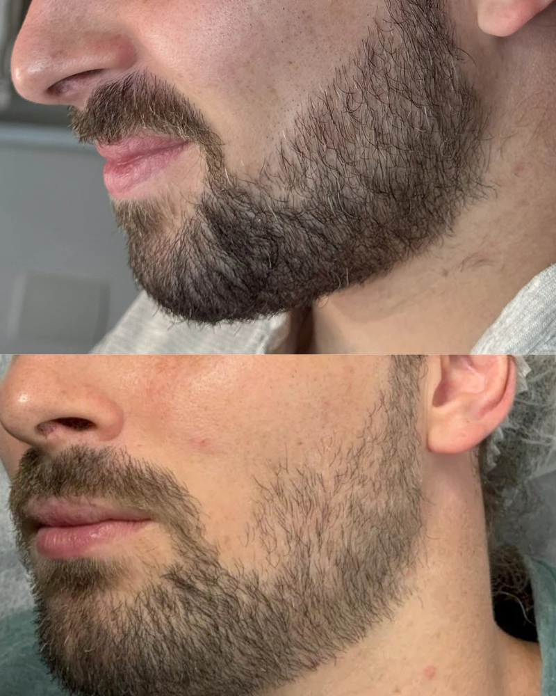 Antes e depois do método Barba