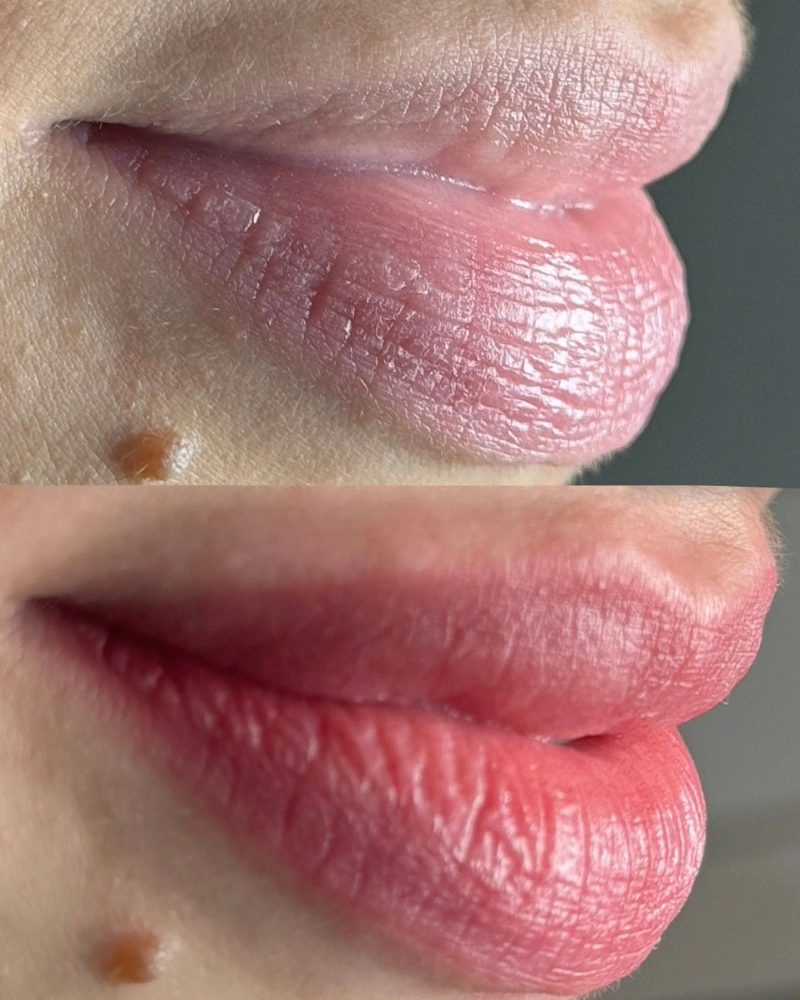 Antes e depois do método InstaLips