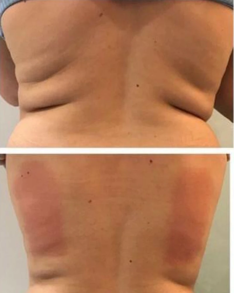 Antes e depois do método Preenchimento Labial