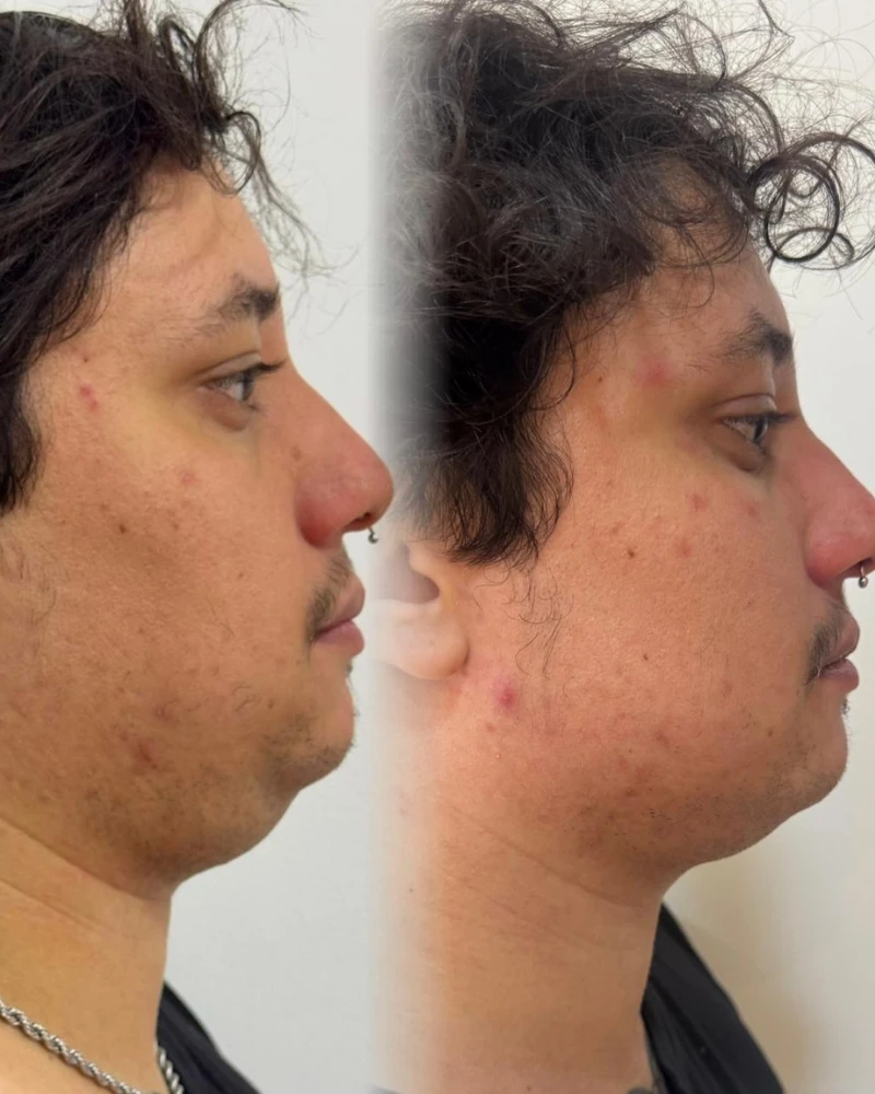 Resultado natural de tratamento com Preenchimento Labial