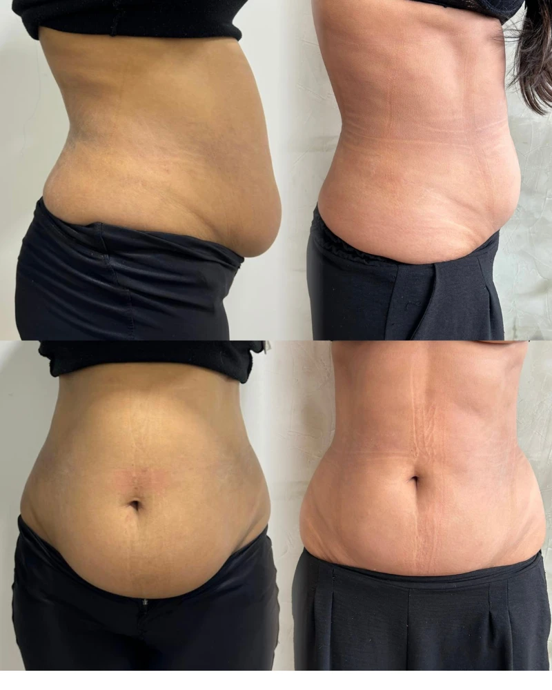 Antes e depois do Preenchimento Labial