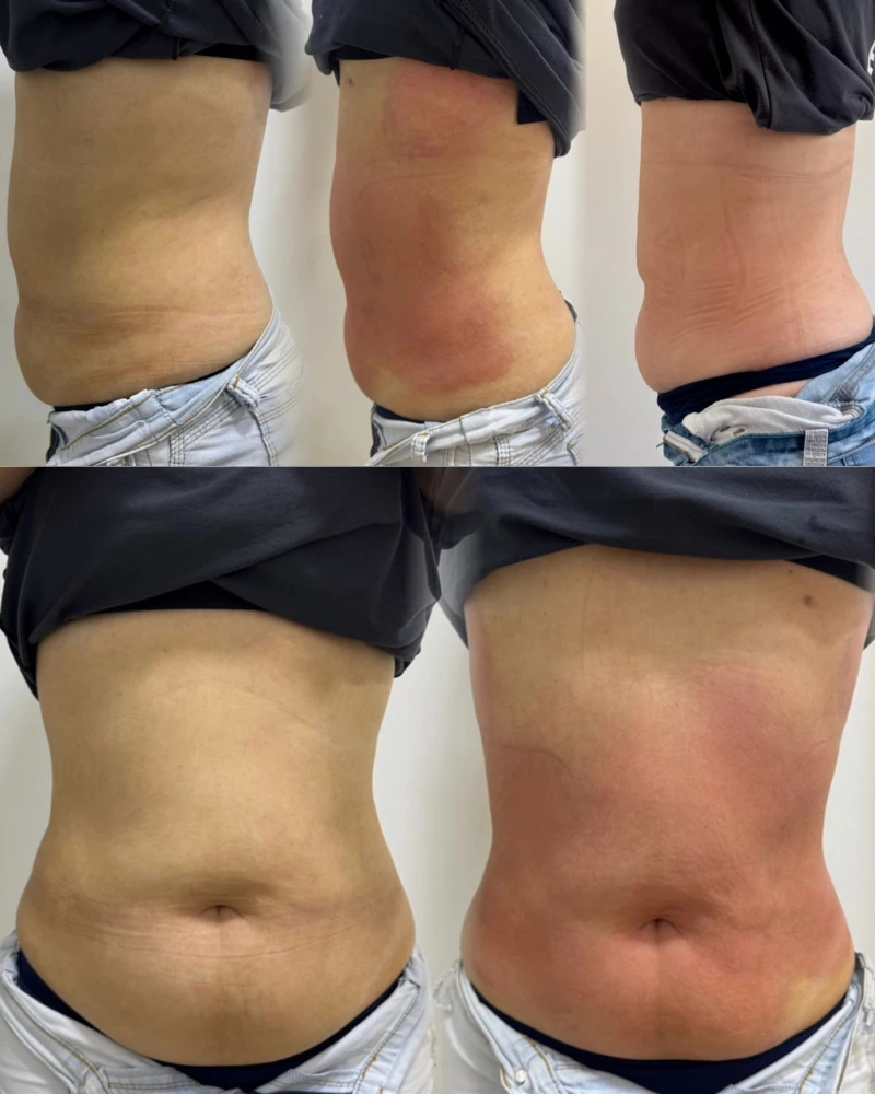 Resultado de Preenchimento Labial com expressão natural