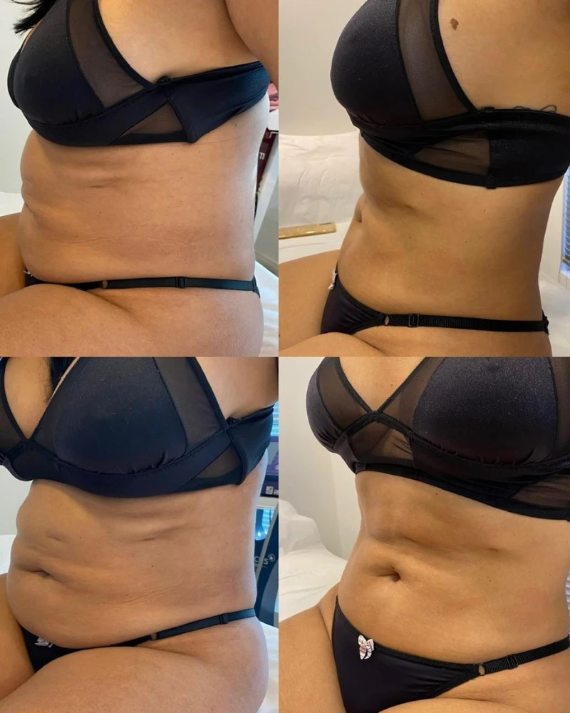 Comparativo antes e depois do método Preenchimento Labial