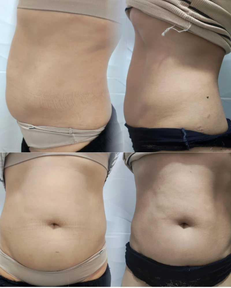 Resultado natural de tratamento com Preenchimento Labial